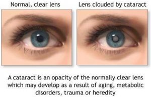 cataract-picture-c-300x240