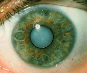 cataract1