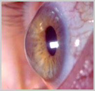 keratoconus