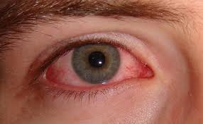 red eye blepharitis